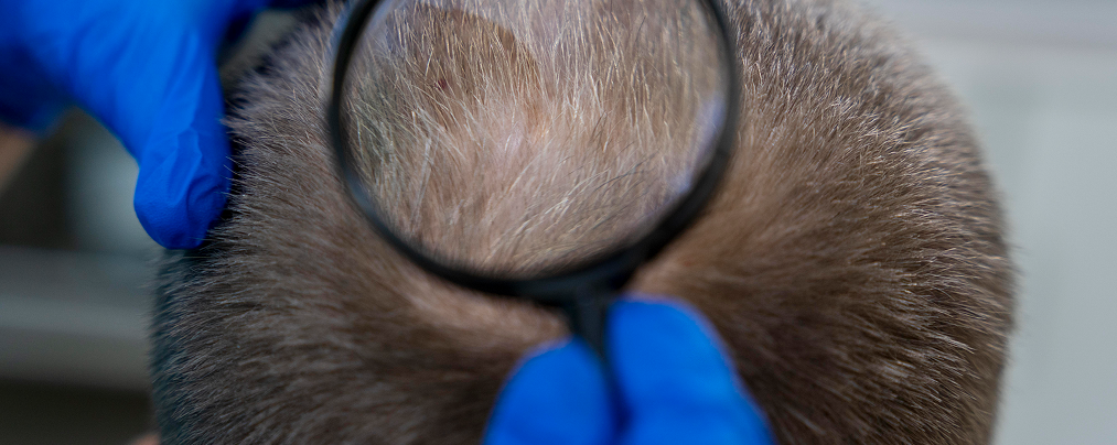 Tratamento de Doenças do Couro Cabeludo Controle e tratamento de dermatite seborreica, psoríase, caspa intensa, foliculite e outras alterações que comprometem a saúde capilar. O foco é reduzir inflamações e reequilibrar o ambiente do couro cabeludo